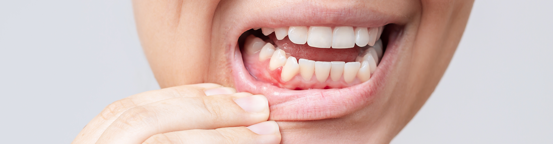Woman pulling down bottom lip to show red gums.